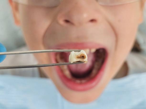 Best Emergency Dentist for Knocked-Out Tooth in Cairo, GA